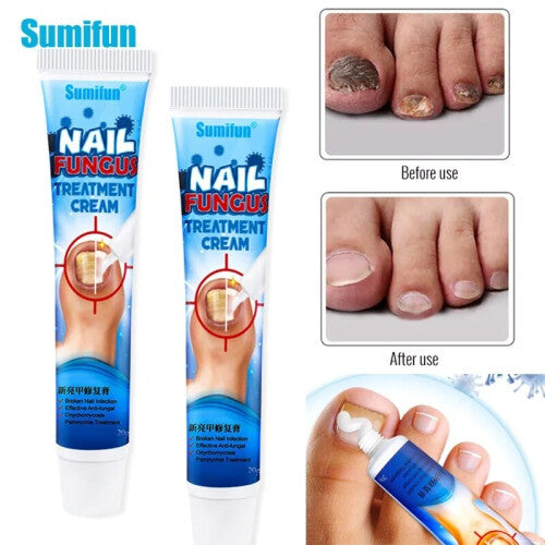 NAL FUNGUS